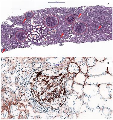 Myocardial infarction with non-obstructive coronary arteries in a patient double-seropositive for anti-glomerular basement membrane and anti-neutrophil cytoplasmic antibodies: A case report